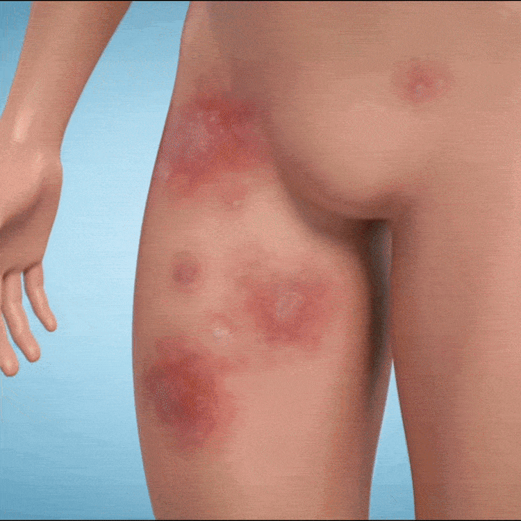غسول جسم مضاد للفطريات للعناية بالبشرة الفطرية | فيوريسكاس