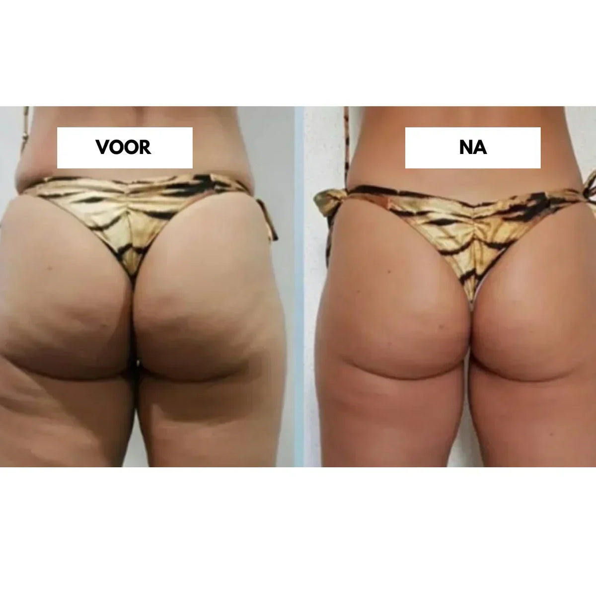 Hloubková vakuová masáž CelluLift pro pevnější pokožku | Fioriscas