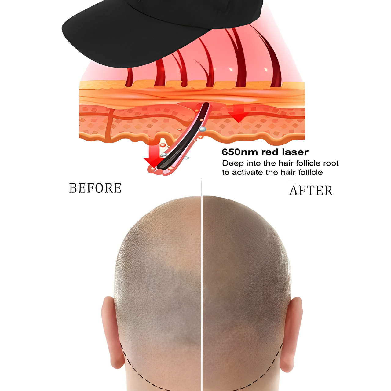 Cuffia laser per la crescita dei capelli con luce rossa e infrarossa, per uso domestico