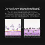 Deluxe Stainless Steel Pore & Blackhead Extractor Tool Kit