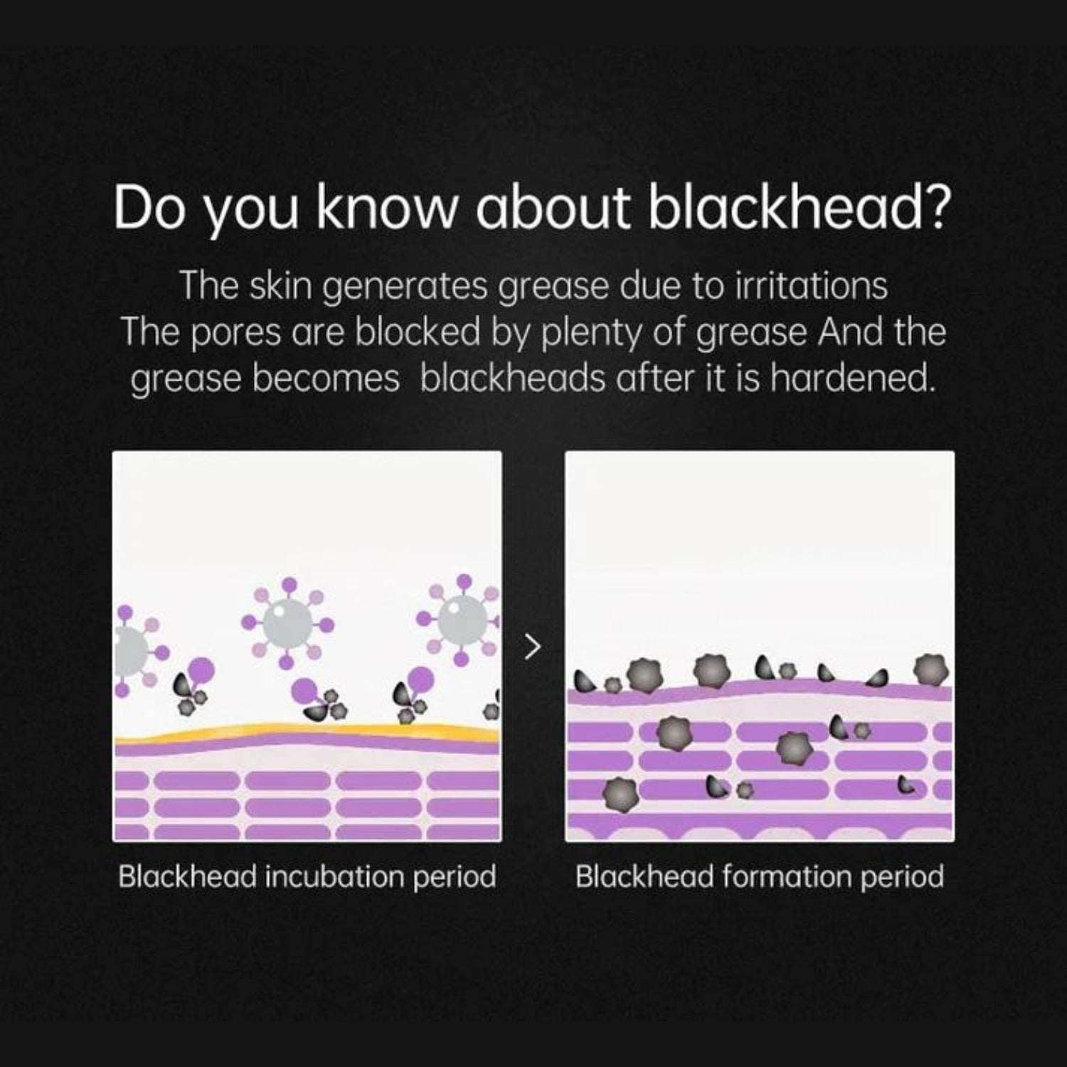 Deluxe Stainless Steel Pore & Blackhead Extractor Tool Kit