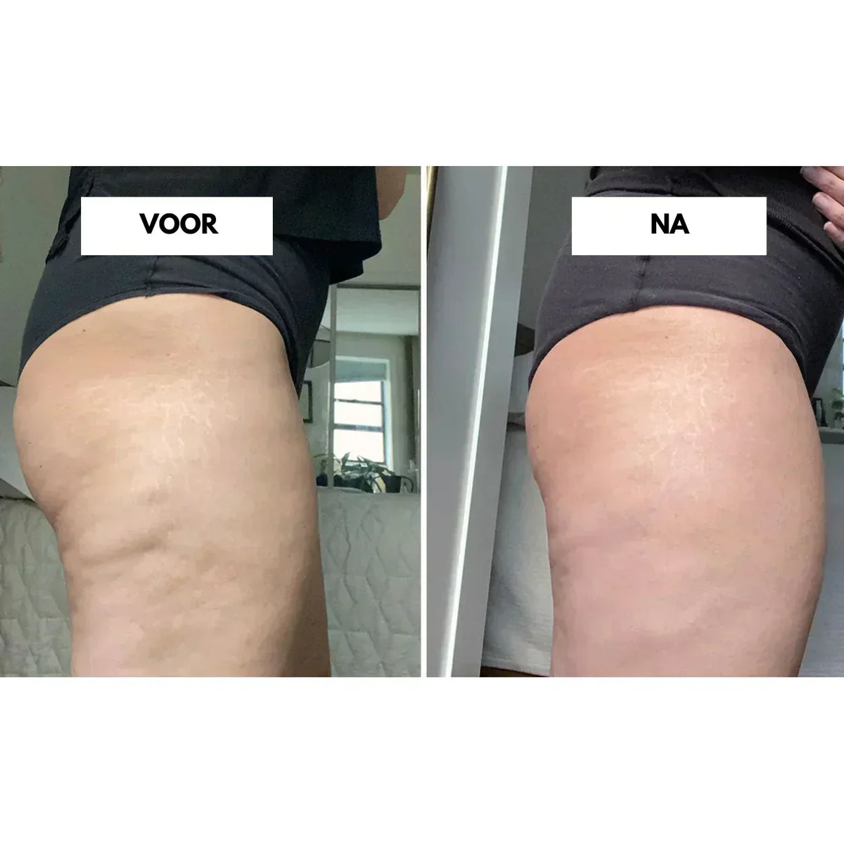 Hloubková vakuová masáž CelluLift pro pevnější pokožku | Fioriscas