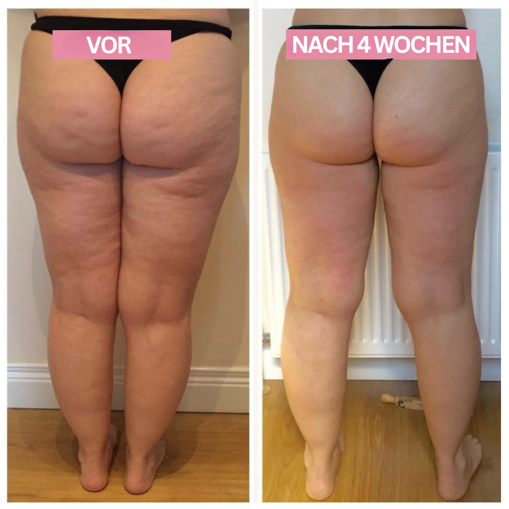 Dispositivo per coppettazione a domicilio Slimcupp per rassodare la pelle e ridurre la cellulite | Fioriscas