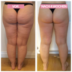 Dispositivo per coppettazione a domicilio Slimcupp per rassodare la pelle e ridurre la cellulite | Fioriscas