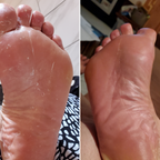 Antifungal rensebar til irriteret hud | Fioriscas