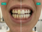 Irrigador oral portátil e kit de branqueamento para limpeza dos dentes | Fioriscas