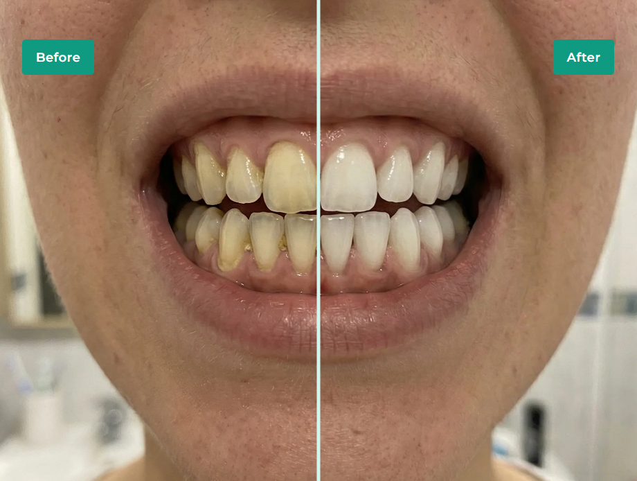 Irrigador oral portátil e kit de branqueamento para limpeza dos dentes | Fioriscas