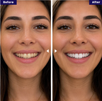 Purple PAP Whitening Strips for a Brighter Smile | Fioriscas
