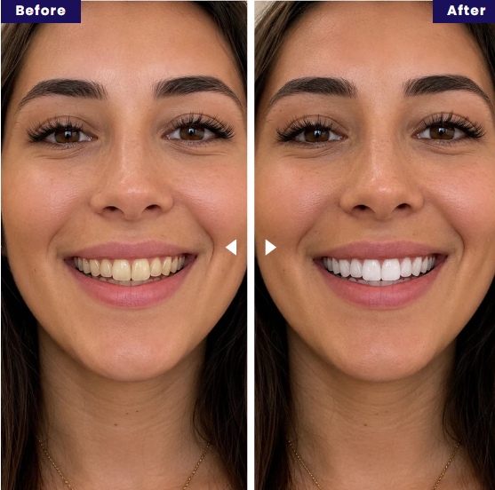 Purple PAP Whitening Strips for a Brighter Smile | Fioriscas