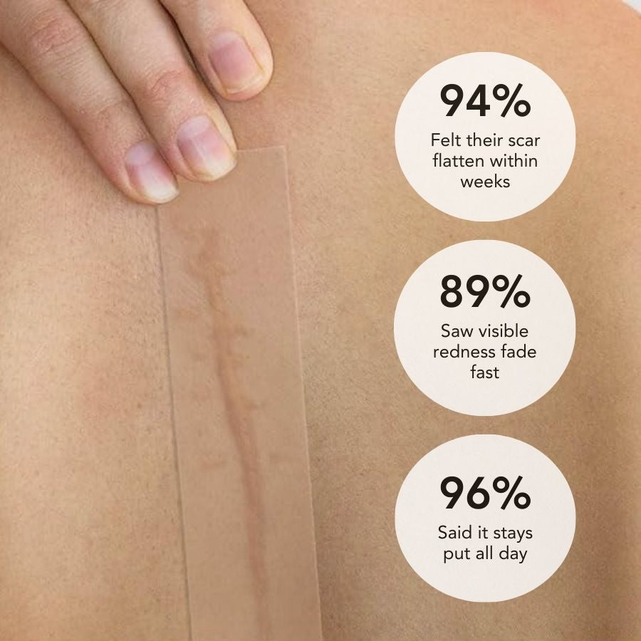 Silikonowa taśma SilkScar | Medyczna terapia blizn zapewniająca płaskie i miękkie blizny | Fioriscas