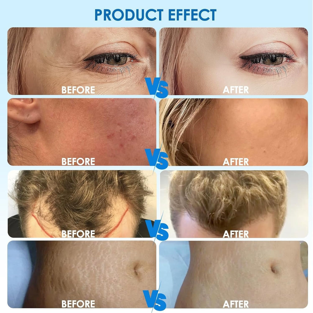 Hydra Pen H3 voor microneedling en seruminsluizing thuis | Fioriscas