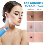 Painless skin tag removal for neck, back & body - Fioriscas
