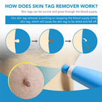 Painless skin tag removal for neck, back & body - Fioriscas