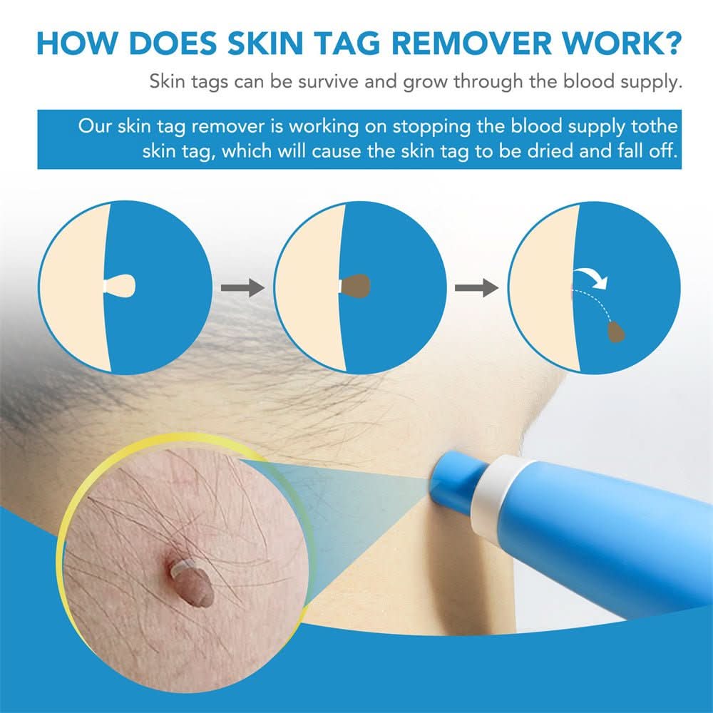 Painless skin tag removal for neck, back & body - Fioriscas
