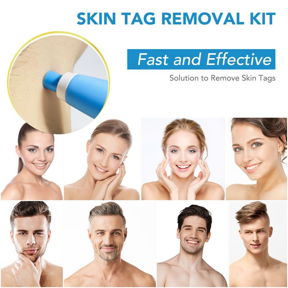 Painless skin tag removal for neck, back & body - Fioriscas