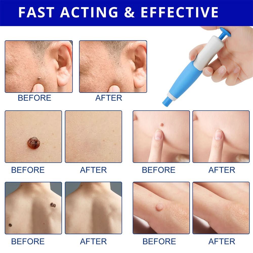 Painless skin tag removal for neck, back & body - Fioriscas