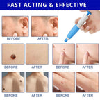 Painless skin tag removal for neck, back & body - Fioriscas