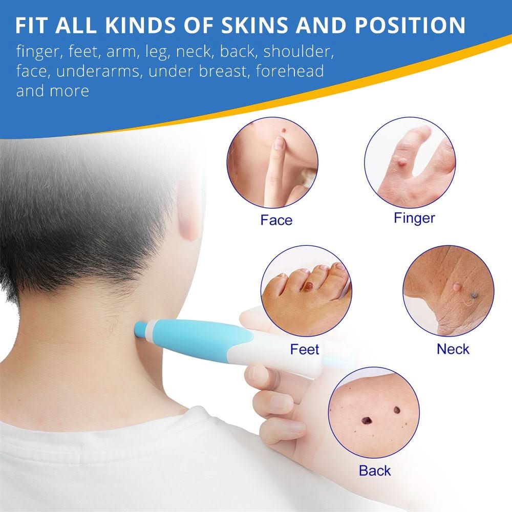 Painless skin tag removal for neck, back & body - Fioriscas