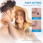 Painless skin tag removal for neck, back & body - Fioriscas