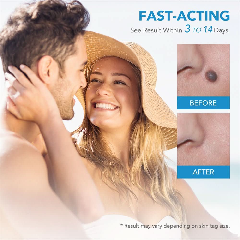 Painless skin tag removal for neck, back & body - Fioriscas