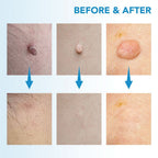 Painless skin tag removal for neck, back & body - Fioriscas