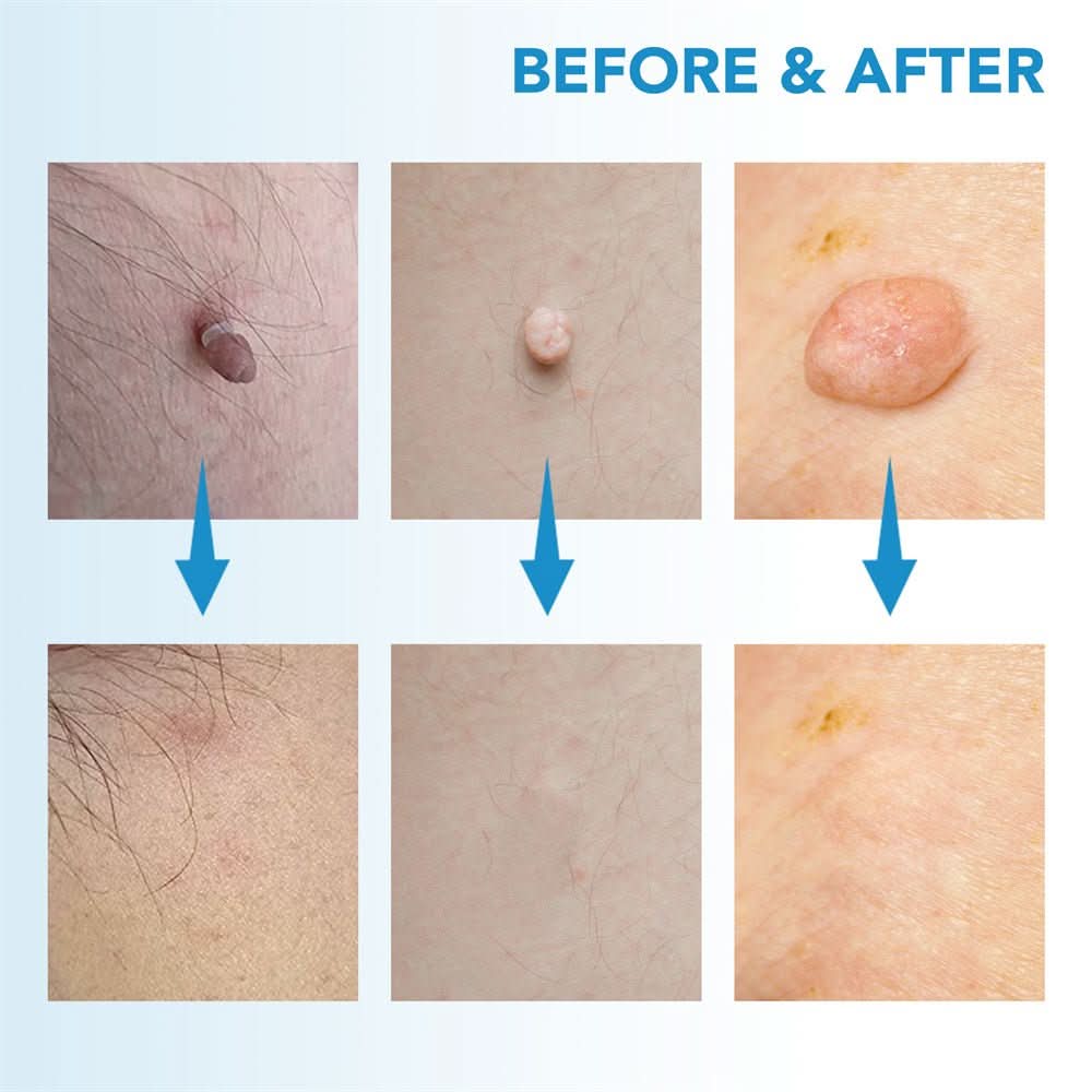 Painless skin tag removal for neck, back & body - Fioriscas