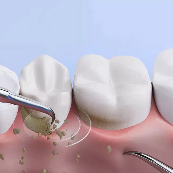 Ultrasone tandplak- en tandsteenverwijderaar, OralPro-tandverzorgingstool voor thuisgebruik