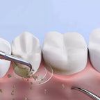 Ultrasone tandplak- en tandsteenverwijderaar, OralPro-tandverzorgingstool voor thuisgebruik