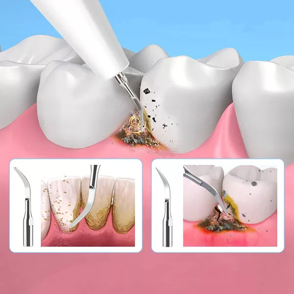 Ultrasone tandplak- en tandsteenverwijderaar, OralPro-tandverzorgingstool voor thuisgebruik