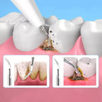 Ultrasone tandplak- en tandsteenverwijderaar, OralPro-tandverzorgingstool voor thuisgebruik