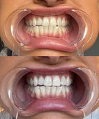 Bandes blanchissantes pour les dents sensibles | Blanchiment professionnel à domicile | Fioriscas