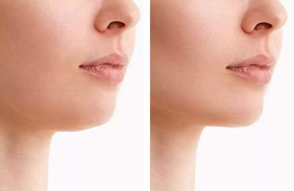 ChinContour NovaLume Red Light Jaw Wrap, Cordless, 4 Modes