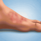 Antifungal rensebar til irriteret hud | Fioriscas