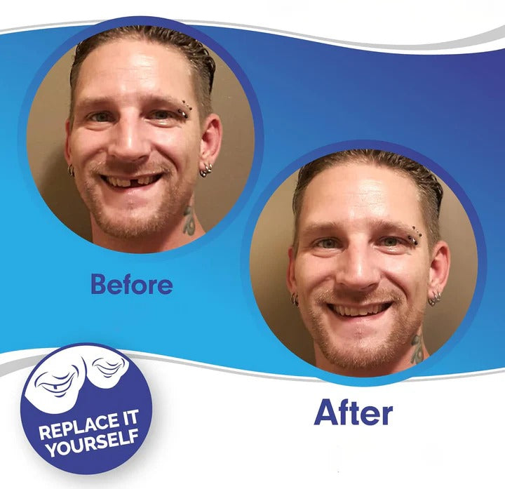 Removable Smile Veneers for Upper and Lower Teeth