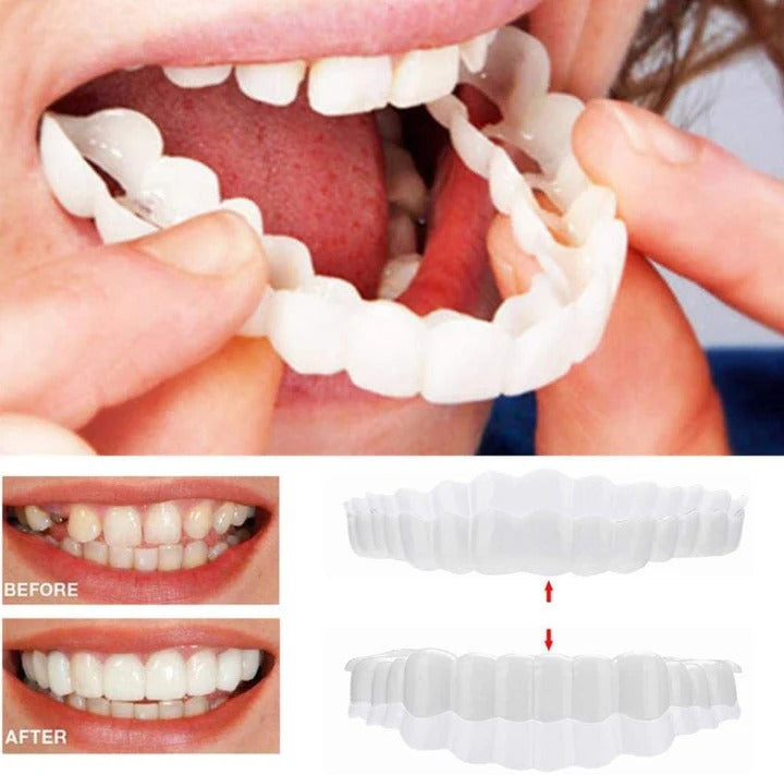 Removable Smile Veneers for Upper and Lower Teeth
