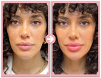 NovaLips Lip Plumping System For Home Use With 0.5mm Roller