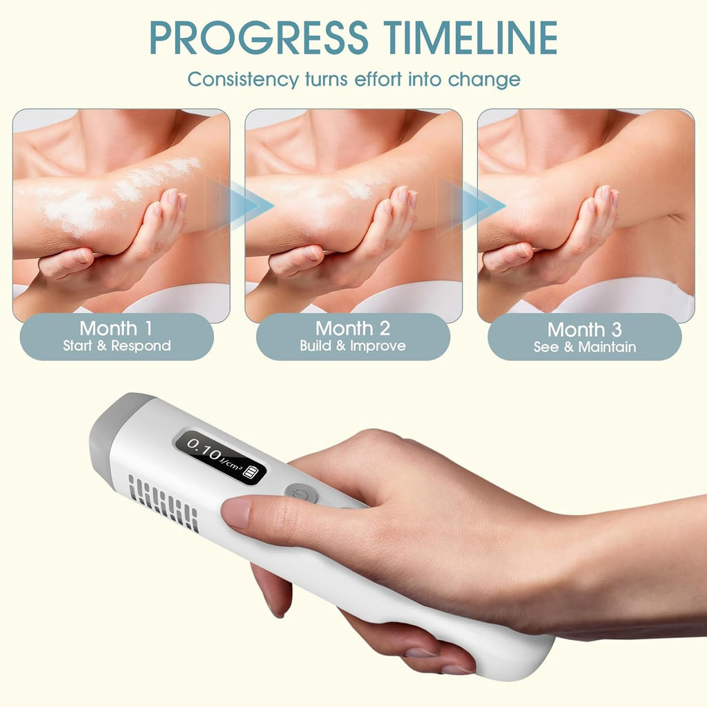 Handheld UVB Light 308nm Device For Home Use Skin Care