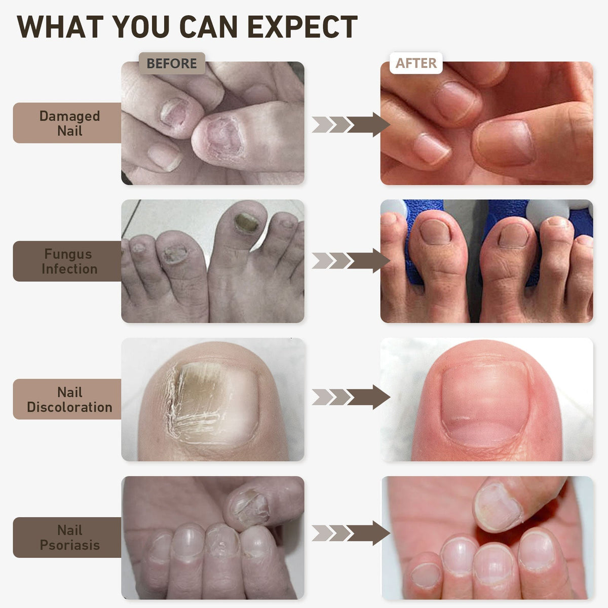 Nail Renewal Light-enhed – Blåt og rødt lys terapi for sundere, klarere negle | Fioriscas