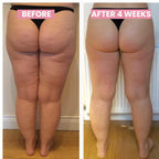 セルライトに悩む女性向け CelluLift 肌引き締めバキュームマッサージ | Fioriscas