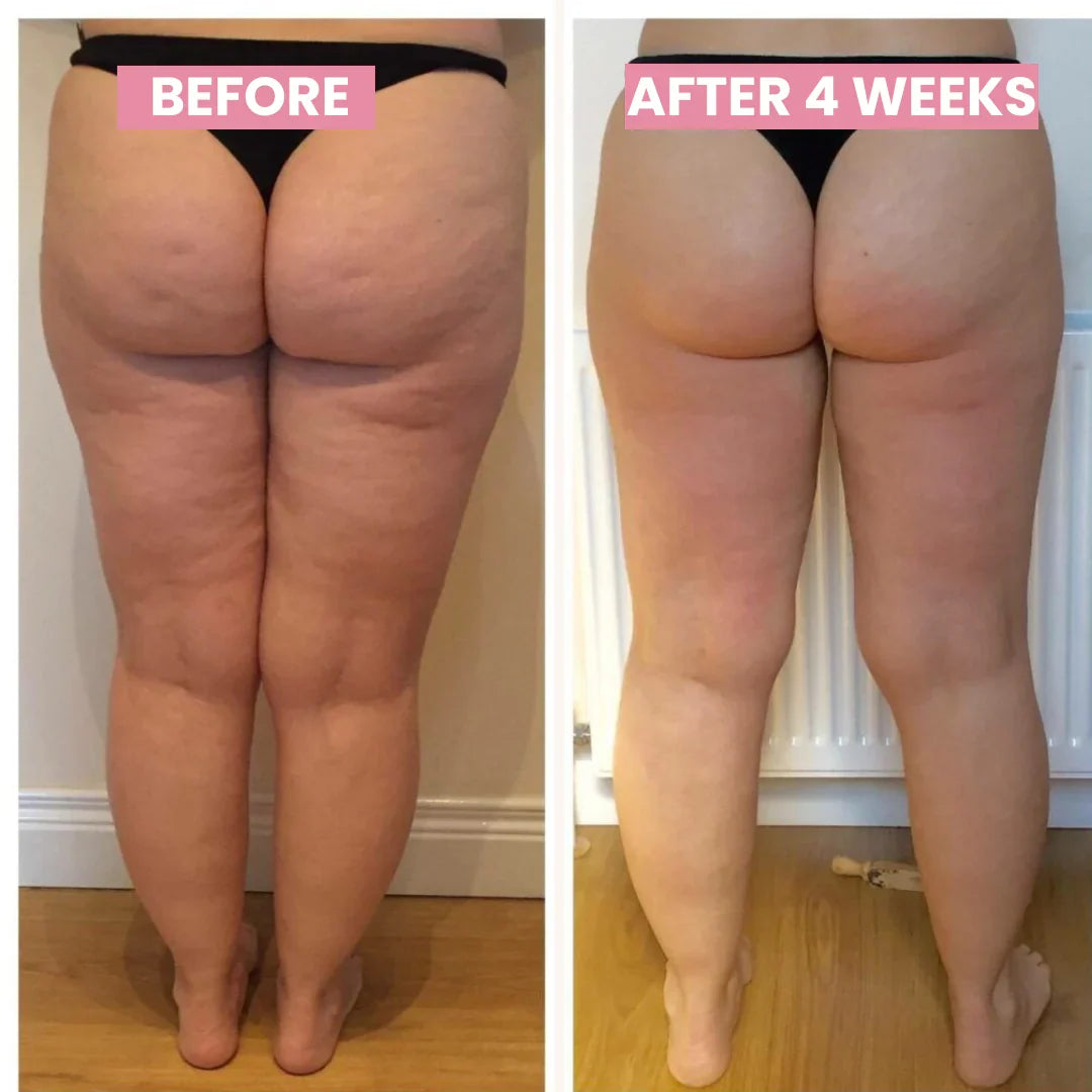 セルライトに悩む女性向け CelluLift 肌引き締めバキュームマッサージ | Fioriscas
